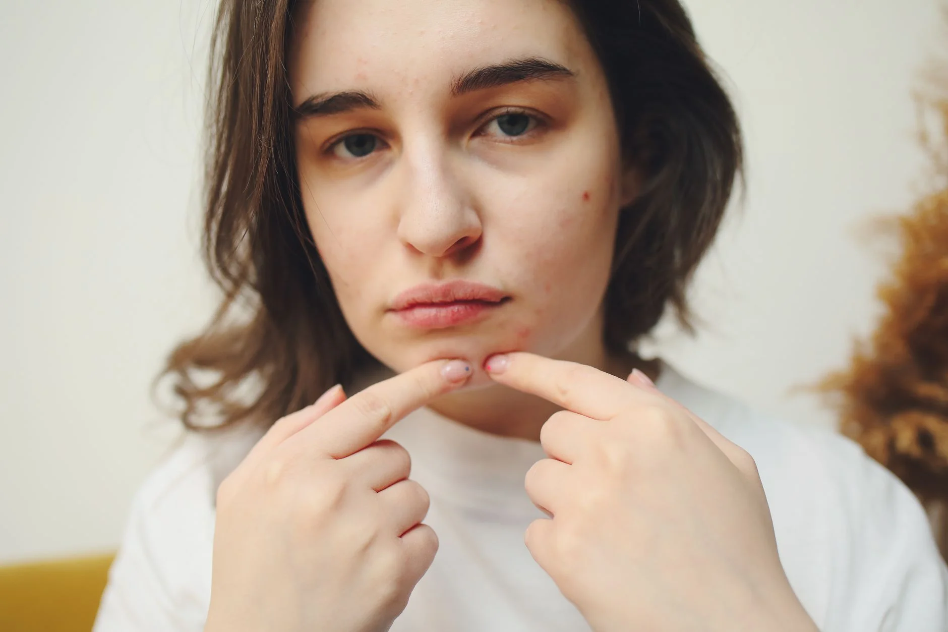 Close-up of a woman with acne touching her face, highlighting skin care concerns. at House of Aetheria, Gurugram
