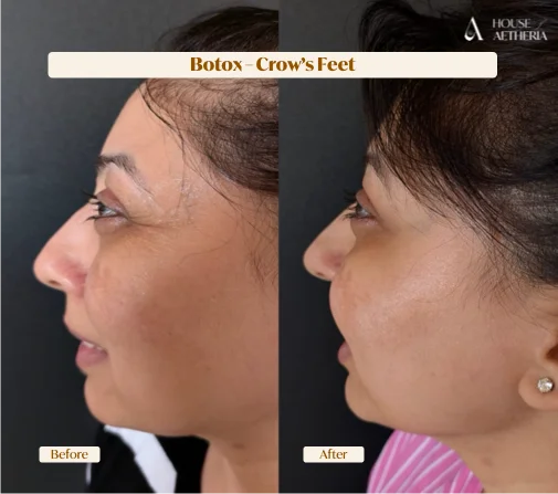 Crow's feet anti-wrinkle treatment before and after — House of Aetheria, Gurgaon