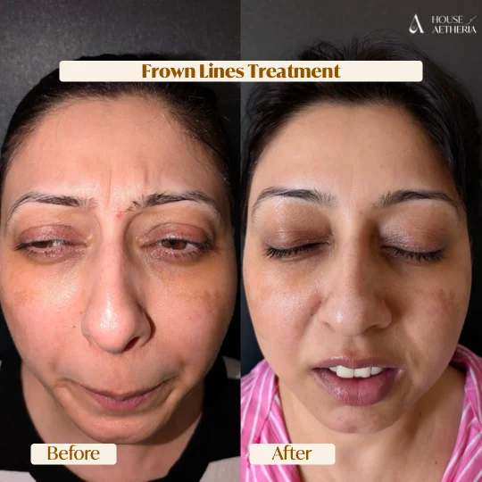 Frown lines anti-wrinkle treatment before and after — House of Aetheria, Gurgaon