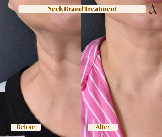 Neck band Nefertiti lift anti-wrinkle treatment before and after — House of Aetheria, Gurgaon