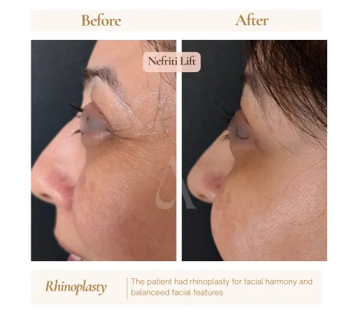 Before and after botox anti-wrinkle injections at House of Aetheria, Gurgaon