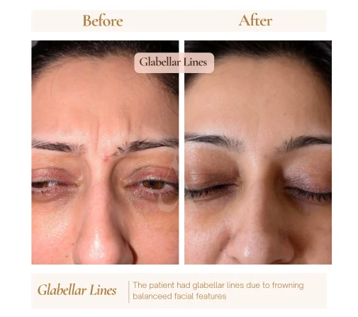 Before and after botox anti-wrinkle injections at House of Aetheria, Gurgaon