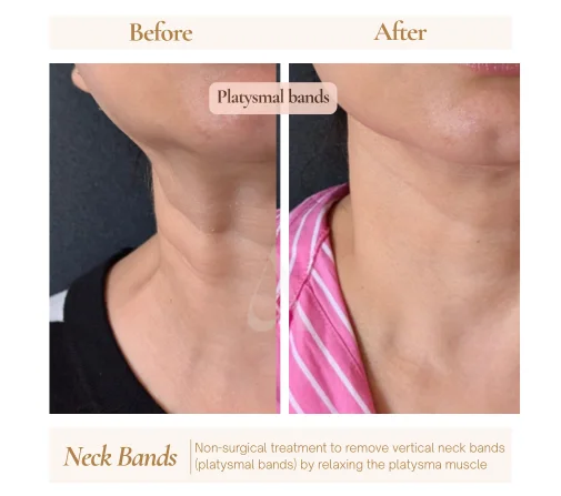 Before and after botox anti-wrinkle injections at House of Aetheria, Gurgaon
