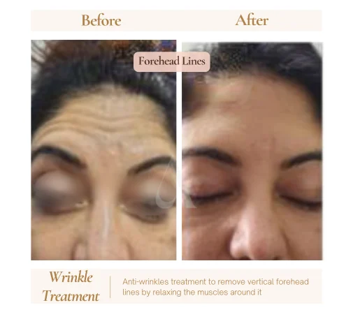 Before and after botox anti-wrinkle injections at House of Aetheria, Gurgaon