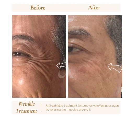 Before and after botox anti-wrinkle injections at House of Aetheria, Gurgaon