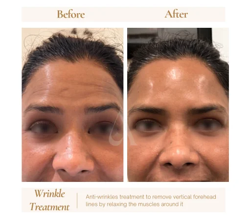 Before and after botox anti-wrinkle injections at House of Aetheria, Gurgaon