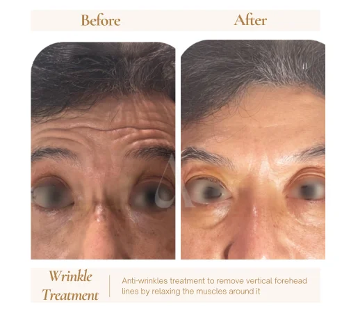 Before and after botox anti-wrinkle injections at House of Aetheria, Gurgaon