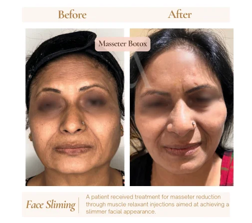 Before and after botox anti-wrinkle injections at House of Aetheria, Gurgaon