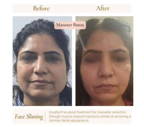 Before and after botox anti-wrinkle injections at House of Aetheria, Gurgaon