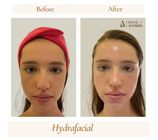 Before and after HydraFacial treatment at House of Aetheria, Gurugram — patient 1