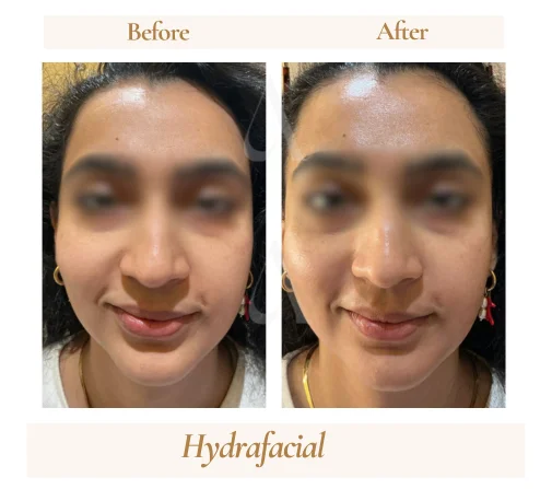 Before and after HydraFacial treatment at House of Aetheria, Gurugram — patient 2