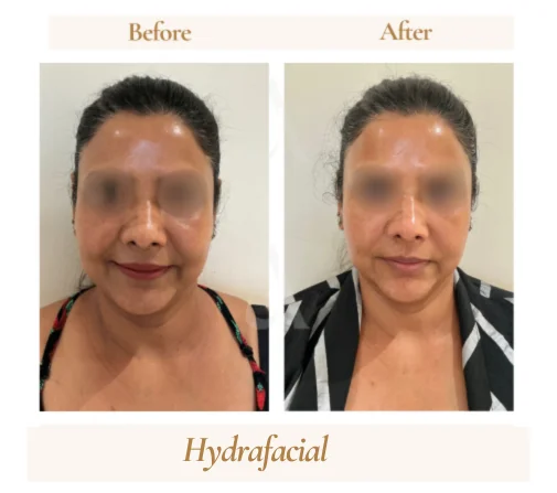 Before and after HydraFacial treatment at House of Aetheria, Gurugram — patient 3