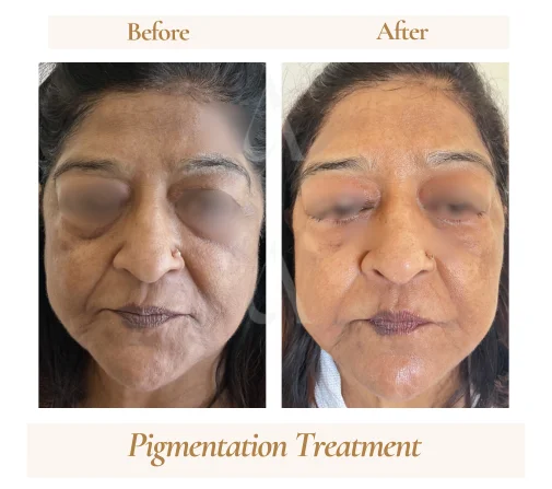 Uneven skin tone treatment result — House of Aetheria Gurugram