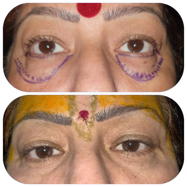 Eyelid surgery before and after results at House of Aetheria, Gurugram