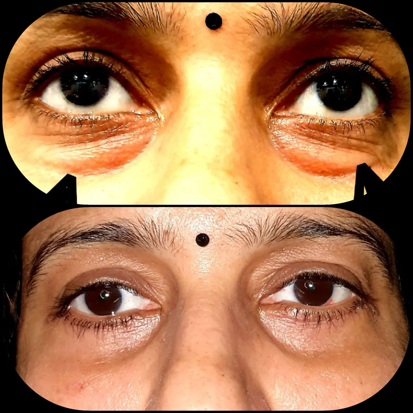 Blepharoplasty before and after results at House of Aetheria, Gurugram