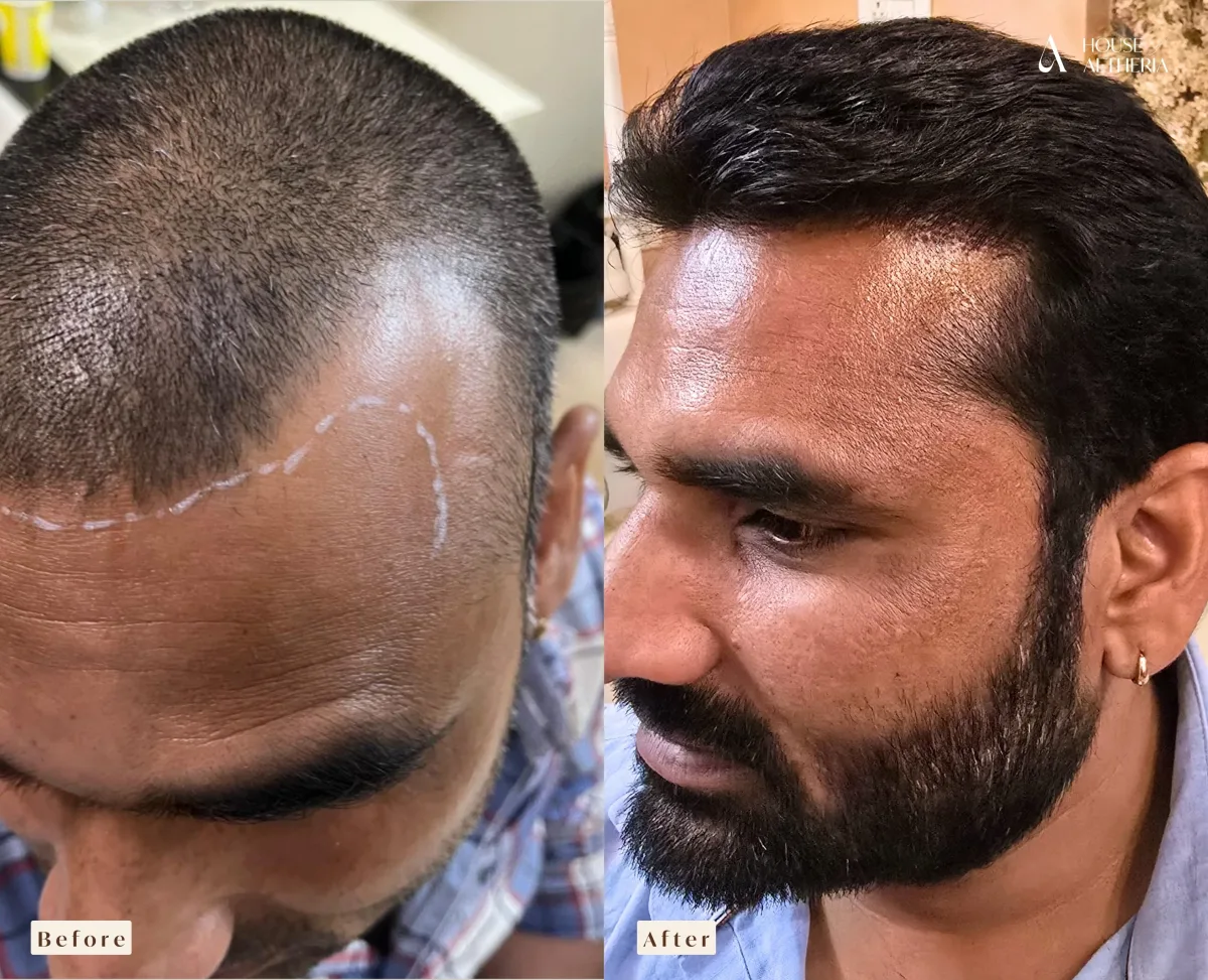 Before and after FUE hair transplant results at House of Aetheria, Gurgaon