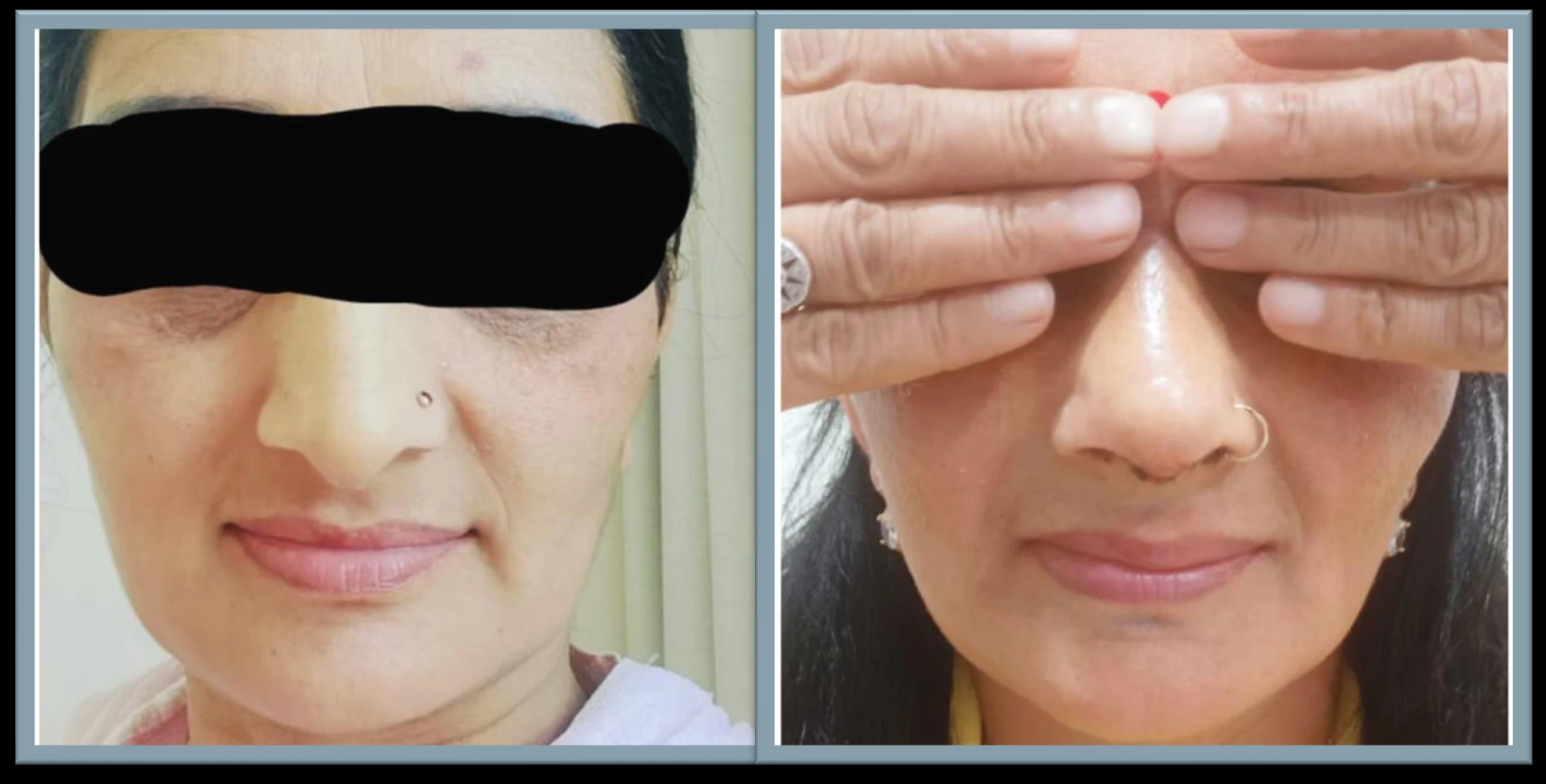Rhinoplasty nose surgery before and after — House of Aetheria, Gurgaon
