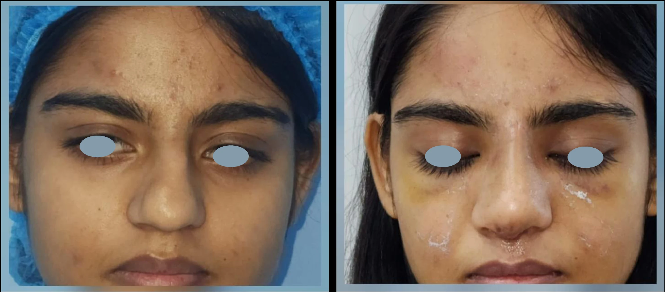 Rhinoplasty nose reshaping before and after — House of Aetheria, Gurgaon