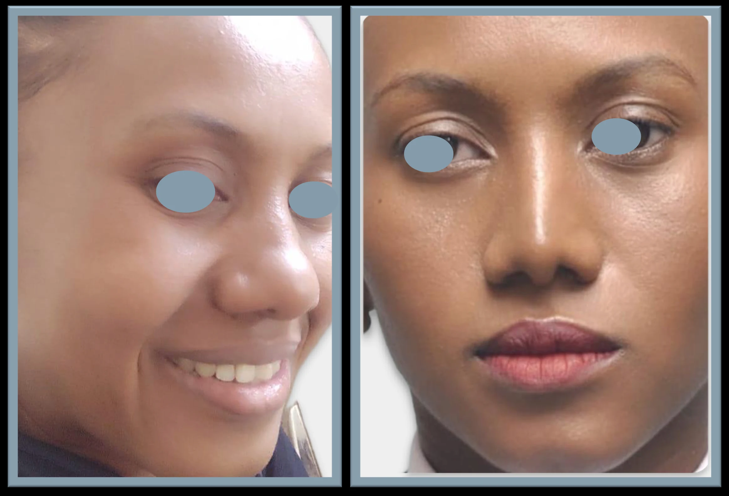 Rhinoplasty nose job before and after — House of Aetheria, Gurgaon