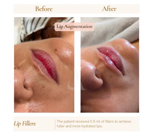 Before and after lip filler for hydration and volume at House of Aetheria, Gurgaon