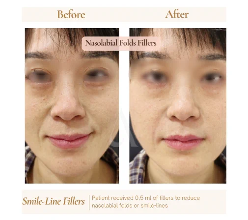 Before and after smile-line nasolabial folds filler at House of Aetheria, Gurgaon