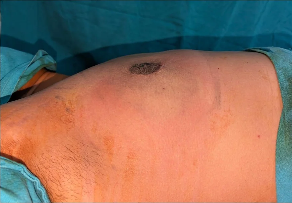 After gynecomastia surgery — flat, natural chest contour, House of Aetheria Gurgaon