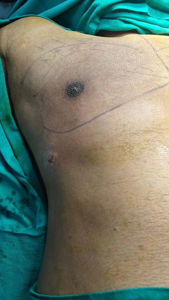 After gynecomastia surgery — flat chest, minimal scarring, House of Aetheria Gurgaon