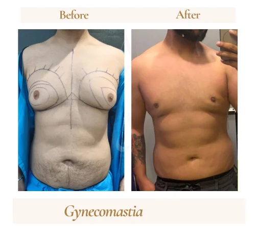 Gynecomastia surgery before and after at House of Aetheria, Gurugram