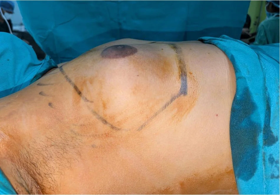 Before gynecomastia surgery — Grade 3 chest enlargement with surgical markings, House of Aetheria