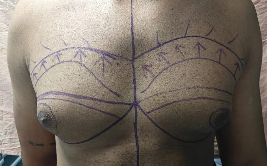 Before gynecomastia surgery — bilateral chest marking, frontal view, House of Aetheria