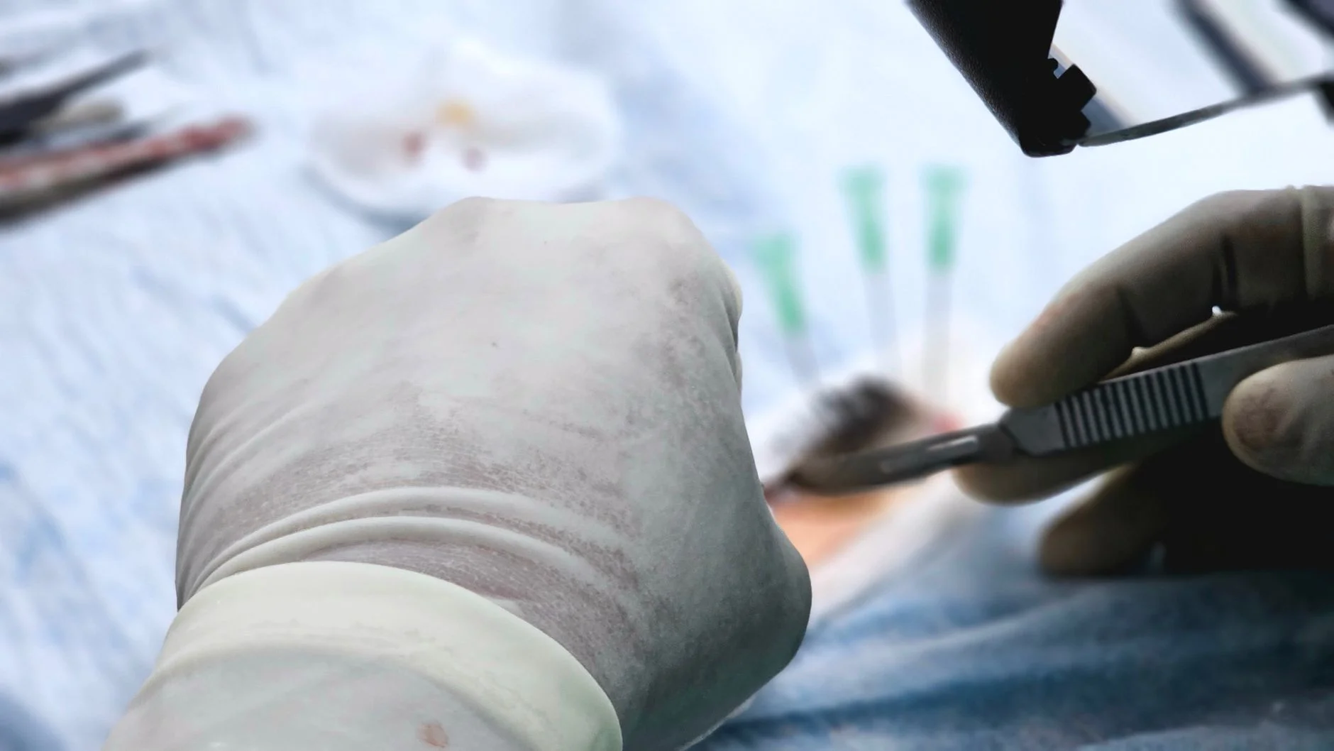 Close-up of a surgical procedure focusing on hair transplant with precision tools. at House of Aetheria, Gurugram