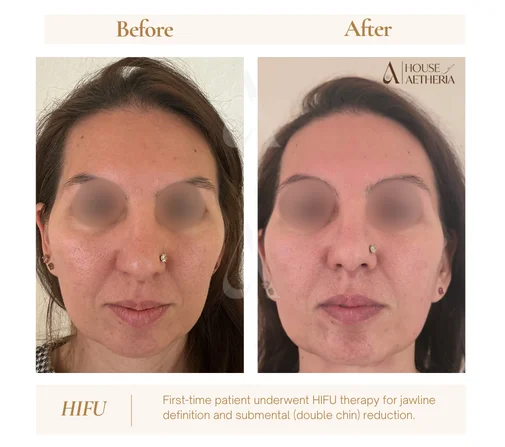 HIFU jawline and double chin before and after at House of Aetheria, Gurugram