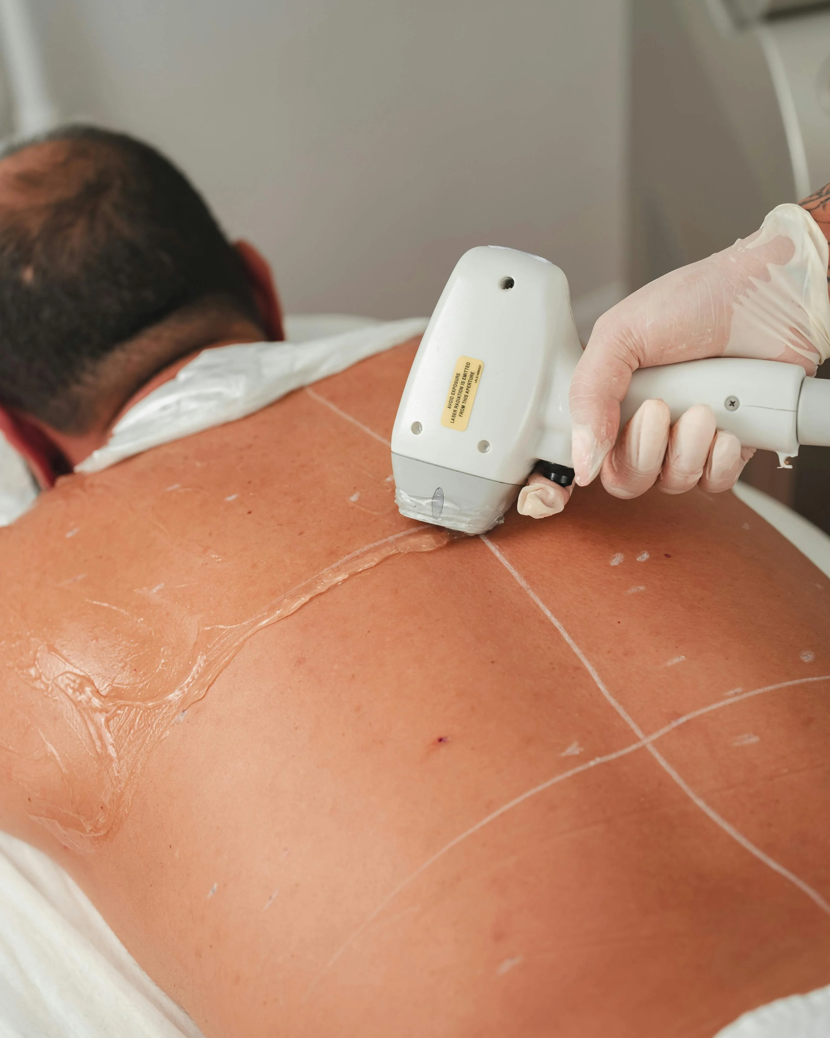 Chest and back laser hair removal — House of Aetheria