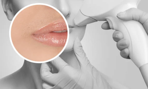 Facial laser hair removal — House of Aetheria