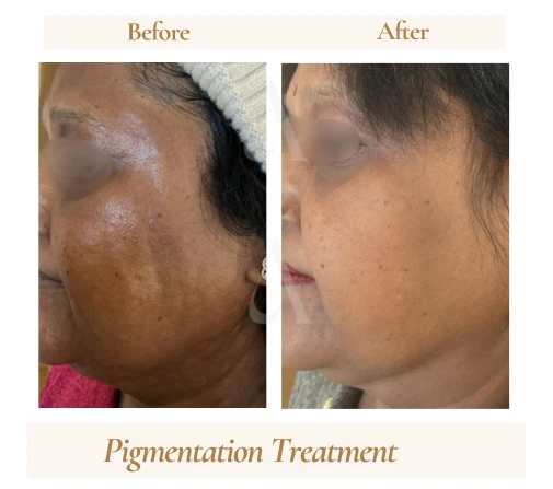 Before and after pigmentation treatment at House of Aetheria, Gurugram