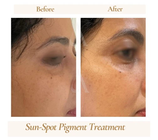 Before and after sun-spot pigment treatment at House of Aetheria, Gurugram