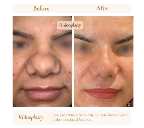 Nose reshaping before and after at House of Aetheria, Gurugram