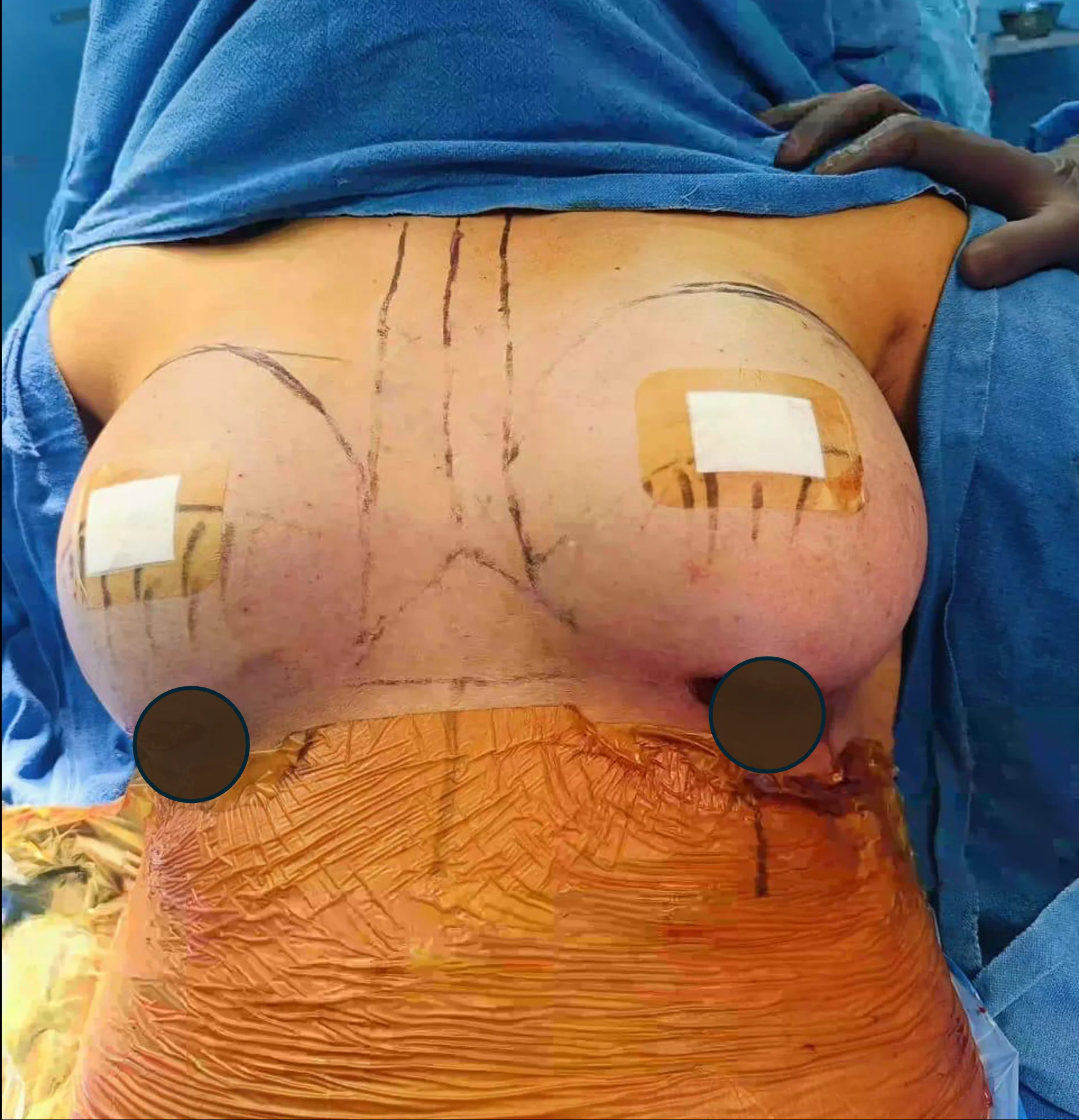 After breast augmentation surgery — result by Dr. Rahul Jain, House of Aetheria, Gurgaon