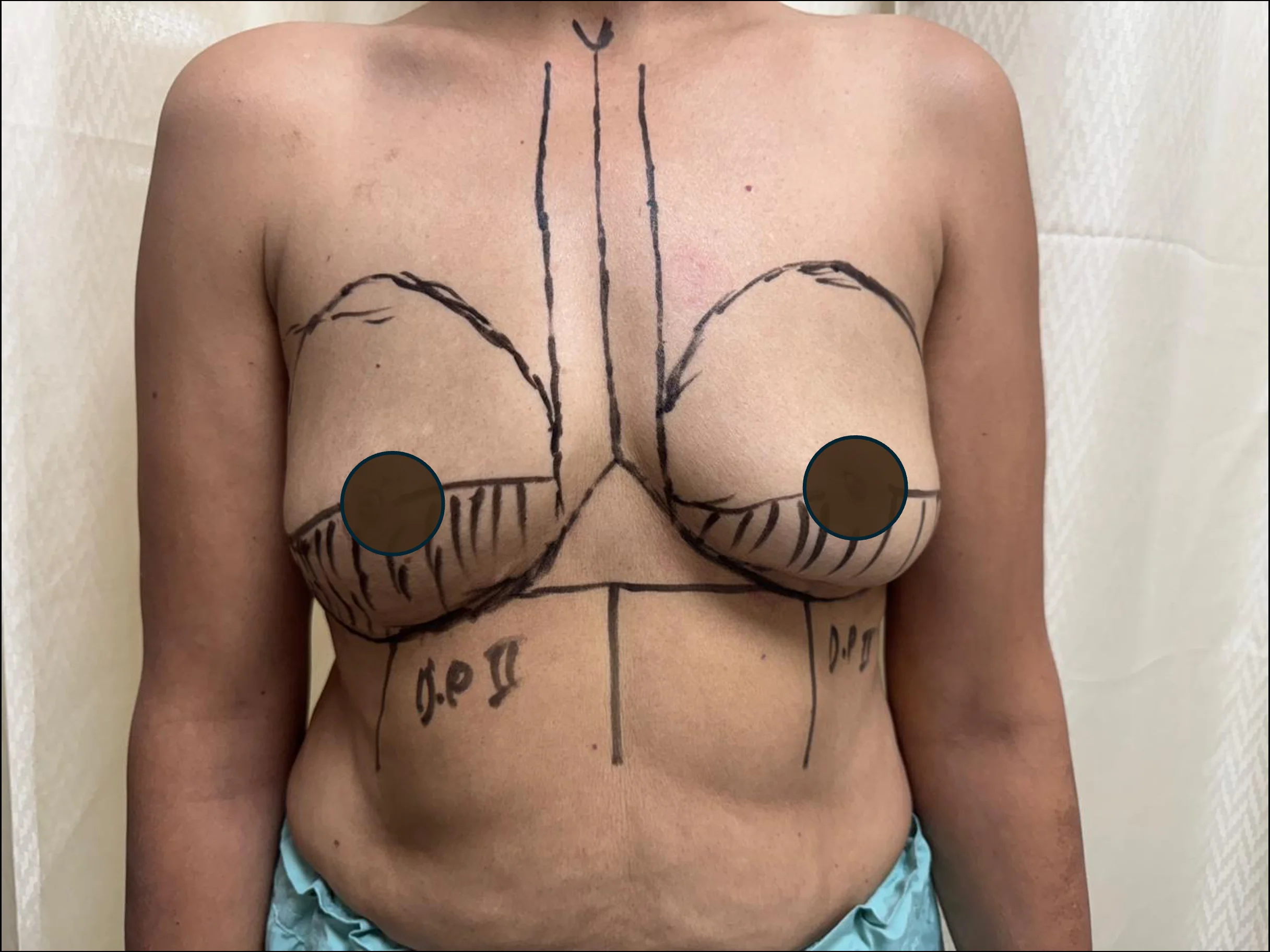 Before breast augmentation surgery — surgical marking at House of Aetheria, Gurgaon