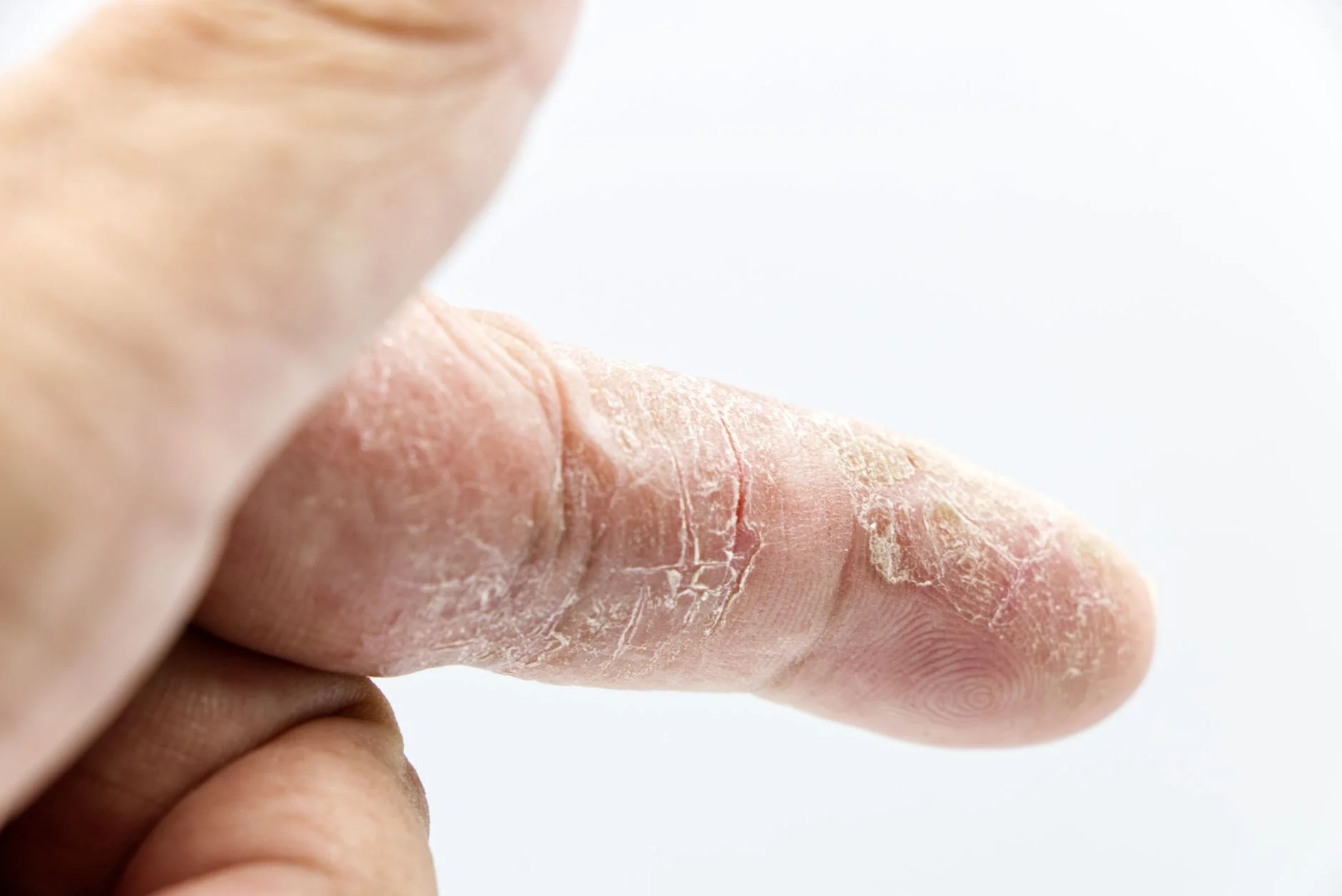 Detailed close-up of a human finger with dry and calloused skin showcasing texture and skin condition. at House of Aetheria, Gurugram