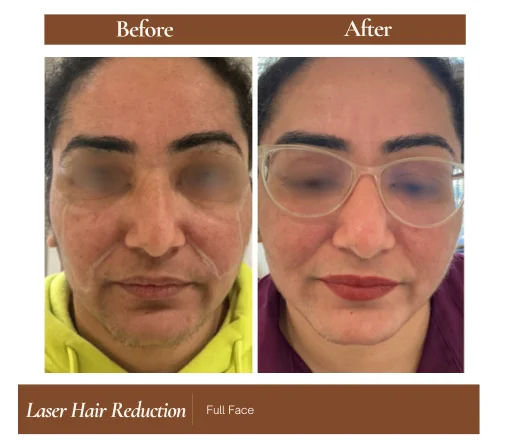 Laser hair reduction before and after — Full Face
