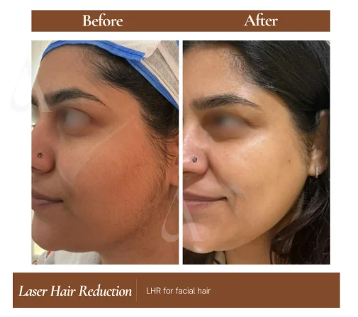 Laser hair reduction before and after — Face Side Profile