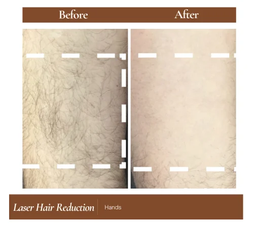 Laser hair reduction before and after — Hands