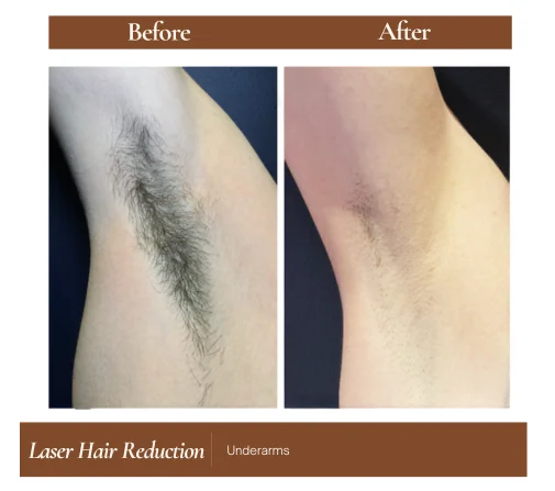 Laser hair reduction before and after — Underarms