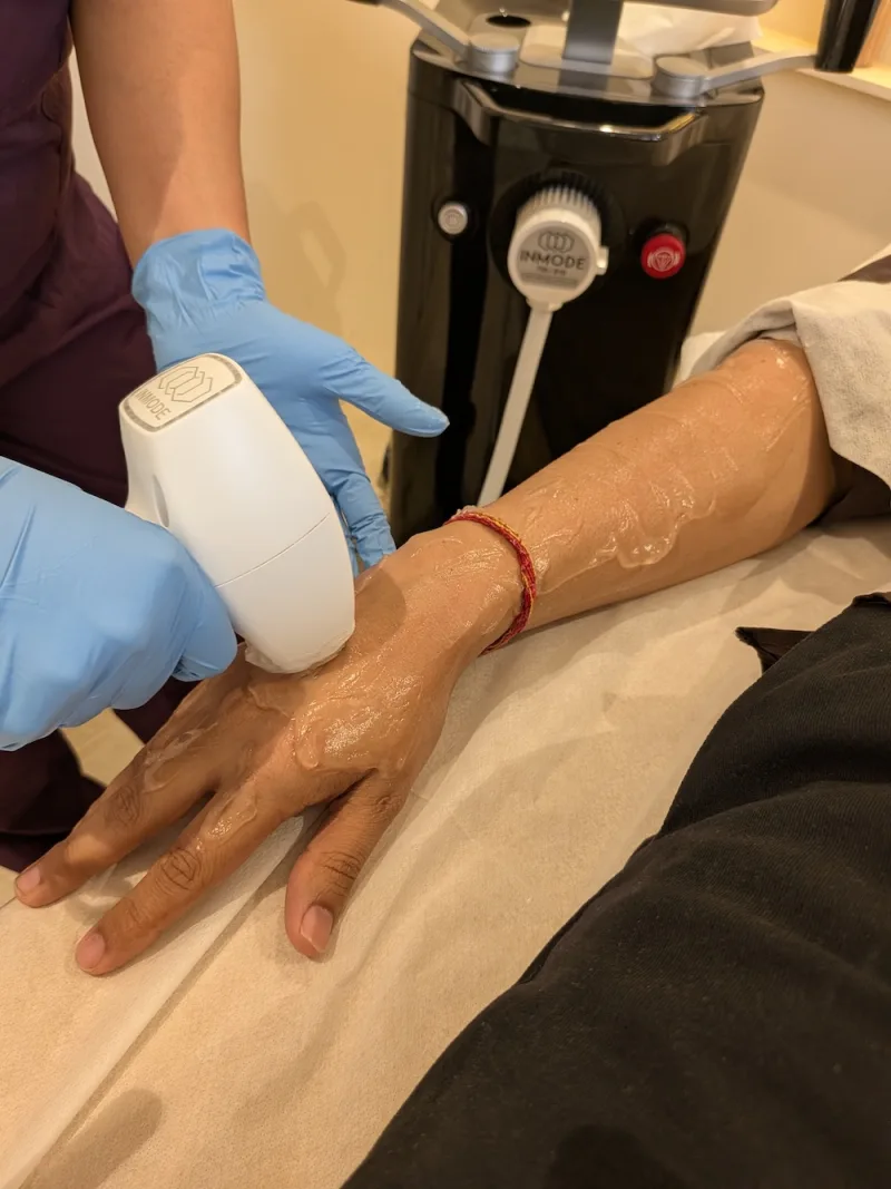 InMode Triton laser hair reduction treatment being performed at House of Aetheria